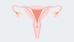 Установка и удаление внутриматочной спирали